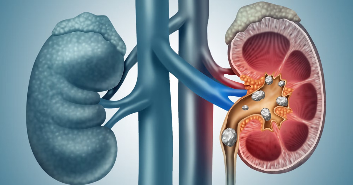 kidney stones causes symptoms diagnosis treatment precautions