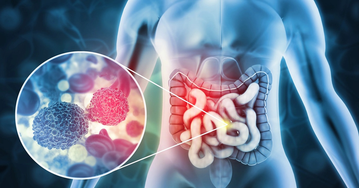 colon cancer on rise young people in india experts cite main reason gen z lifestyle