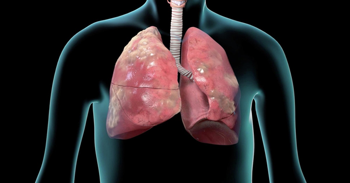 World COPD Day 2025 awareness more than 6 crores indians suffering Chronic Obstructive Pulmonary Disease experts cite 4 mantras